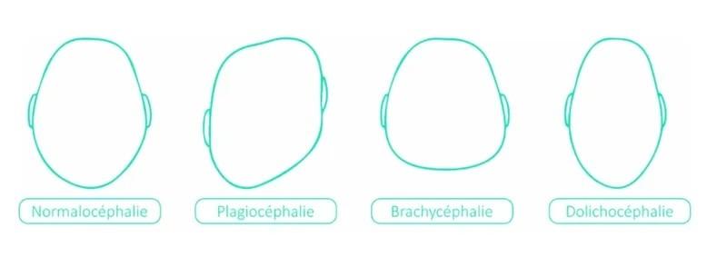 Comment prévenir la plagiocéphalie chez bébé grâce à l'ostéopathie ?
